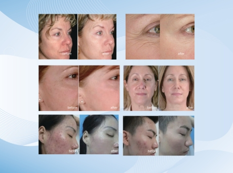 COMax CO2 Fractional Laser